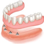 DentureImplant