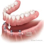 denture-with-4-implants