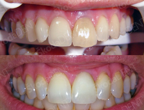 Implantat i press keramika