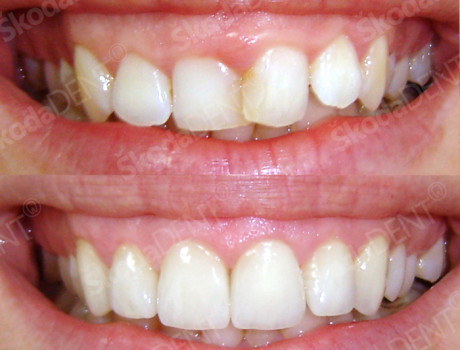 Gingivotomija i keramičke ljuskice