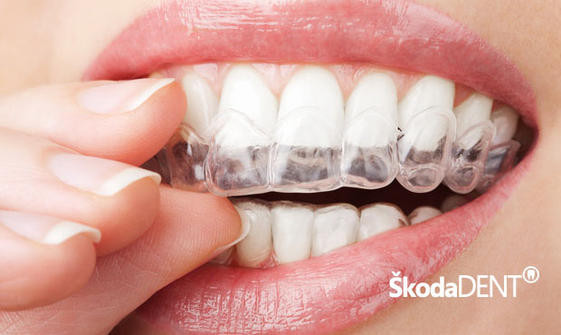 Prozirni aparatić za zube