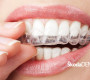 Clear aligner