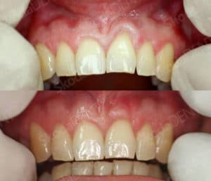gingivoplastika