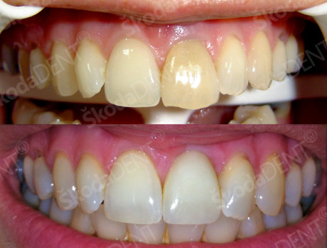 Implant and press ceramic
