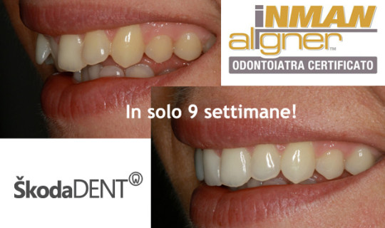 Inman Aligner- L'apparecchio popolare è arrivato anche a Rijeka