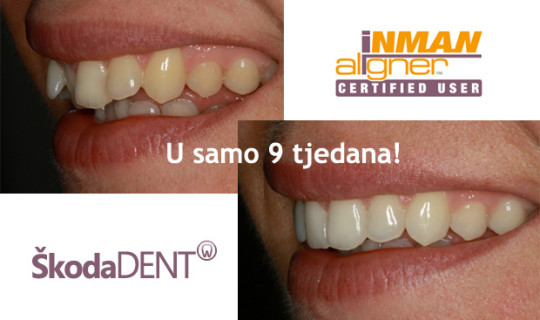 Inman Aligner -poznati aparatić sada i u Rijeci