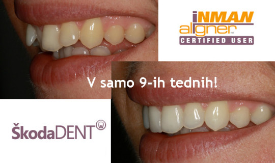 Inman Aligner -poznan aparat zdaj tudi na Reki