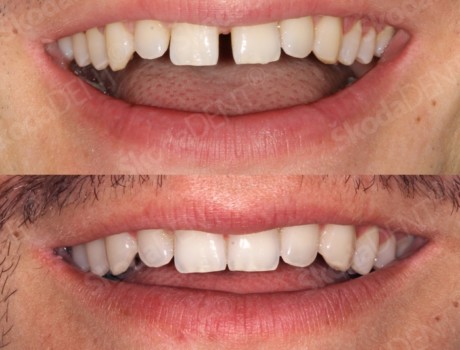 Clear aligner